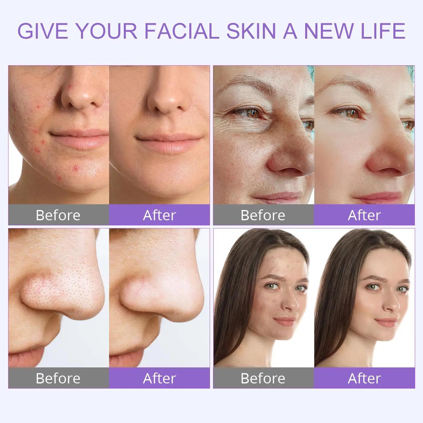 DermDelhi-Machine Hydro-Eau à Oxygène Professionnelle pour Soins de la Peau, Jet Peel Oxy Spray, Liv