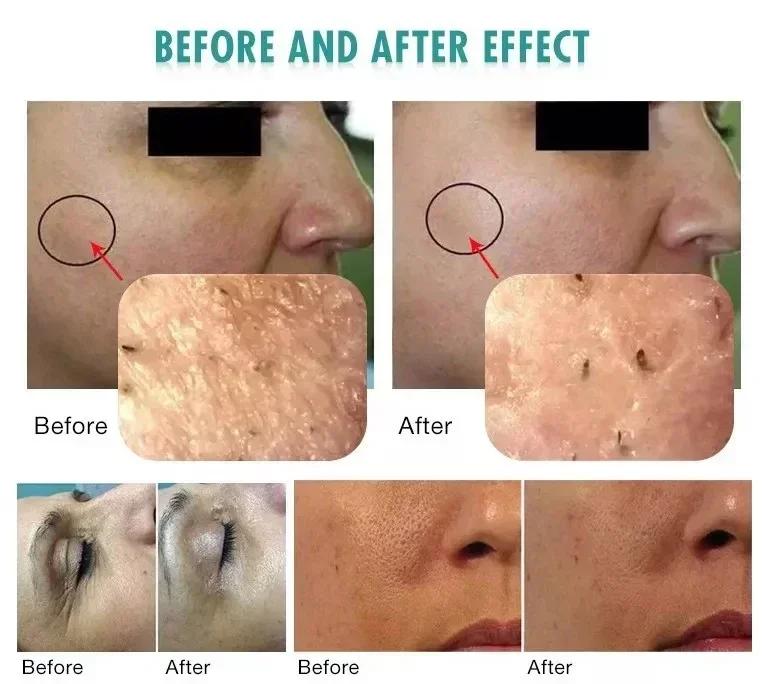 Machine de beauté hydrofaciale 3 en 1, oxygène, rajeunissement de la peau, raffermissement du visage