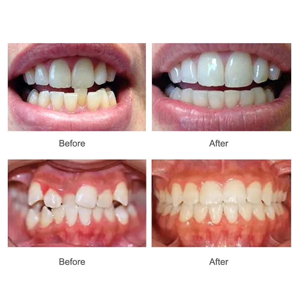 Appareil dentaire, accolades orthodontiques, entraîneur de dents, entraîneur d'alignement, embout po
