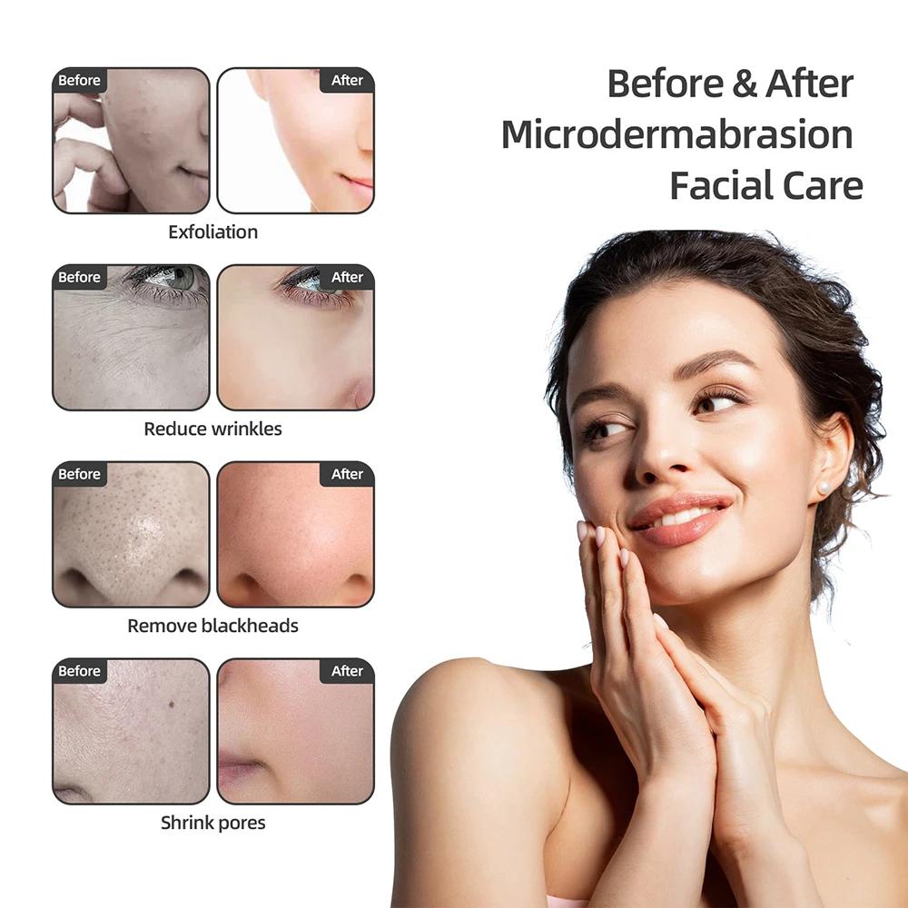 Machine professionnelle de microdermabrasion au diamant, pulvérisation d'eau, exfoliation du visage,