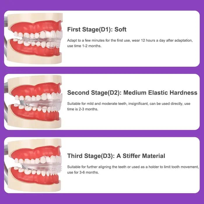 Appareil dentaire, accolades orthodontiques, entraîneur de dents, entraîneur d'alignement, embout po